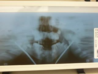 May 21 2009 1 week post op