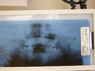 May 4 2009 Pre Op Xray