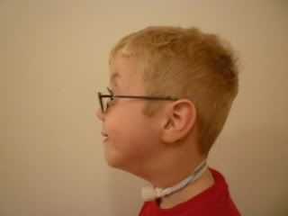 Left profile before surgery 5/12/2009