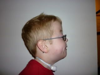 Right Profile before surgery 5/12/2009