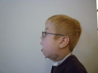Left profile 5th day of turning, 1 week after surgery