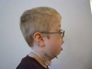 Right profile 5th day of turning , 1 week after surgery